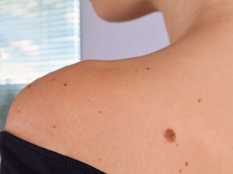 best mole removal anaheim california