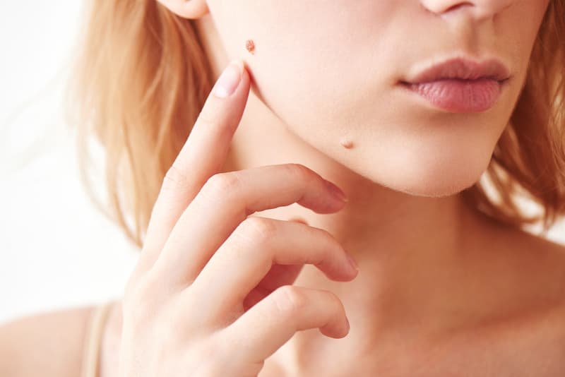 best mole removal santa ana
