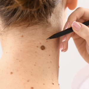 removing mole on neck