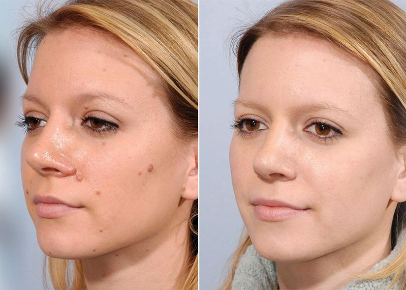 before and after mole removal newport beach