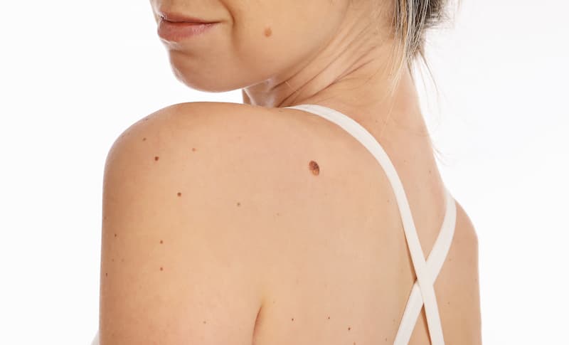 learn about mole removal newport beach