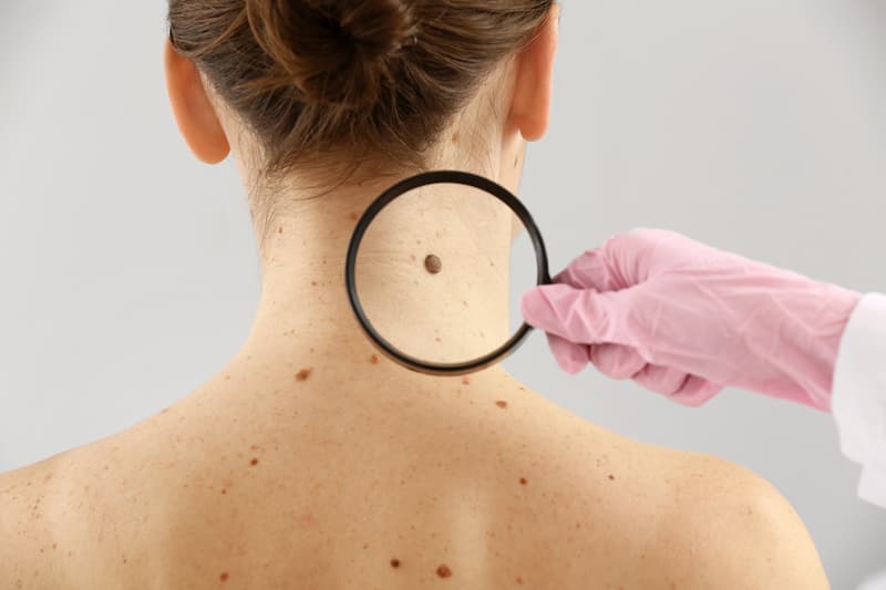 affordable mole removal irvine