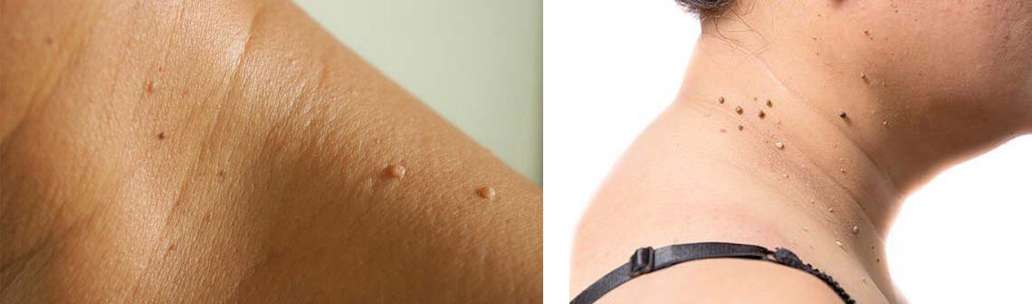 professional skin tag removal orange county california