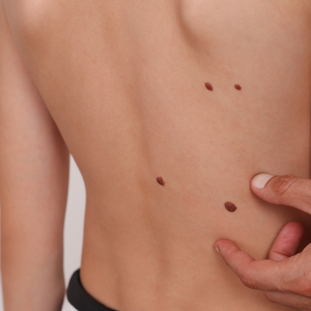 professional mole removal La Habra