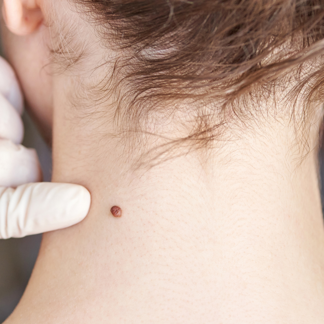 avoid store-bought mole removal products